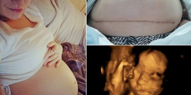 baby's spine 'repaired' in womb