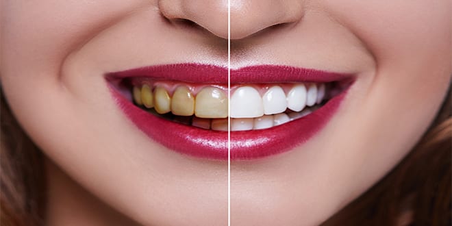 pearl teeth whitening